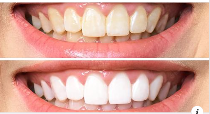 Cách làm trắng răng an toàn và hiệu quả là gì?