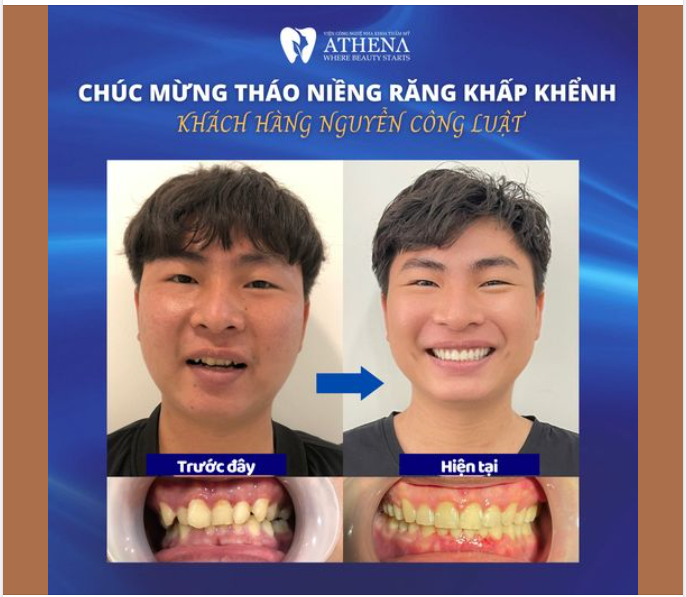 MỪNG THÁO NIỀNG: Kết thúc hành trình điều trị răng khấp khểnh