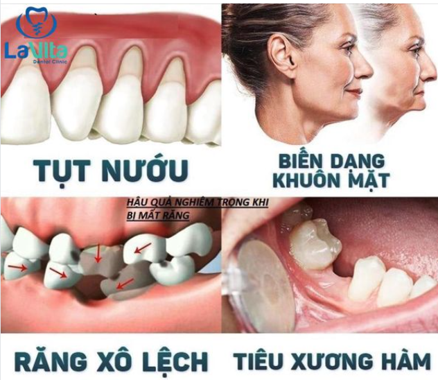 Mất răng là tình trạng tương đối phổ biến và nhiều người gặp phải.
