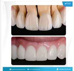 MẶT DÁN SỨ VENEER IPS e.max: Lựa chọn hàng đầu tại Peace Dentistry cho sự hoàn mỹ, tối ưu về chức năng ăn nhai và tối đa về thời gian sử dụng.
