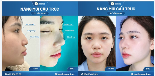 Cập nhật hình ảnh khách hàng sở hữu dáng mũi tự nhiên, hài hòa tại Thẩm mỹ Tuấn Anh