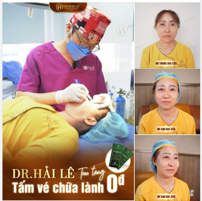 Lục Thị Bình - người phụ nữ từng chung sống 27 năm với mí lỗi hỏng đã may mắn trở thành thí sinh đầu tiên giành tấm vé Giải cứu mí lỗi hỏng/Mí bệnh lý bẩm sinh mùa 7 tại Dr.Hải Lê cơ sở HCM.