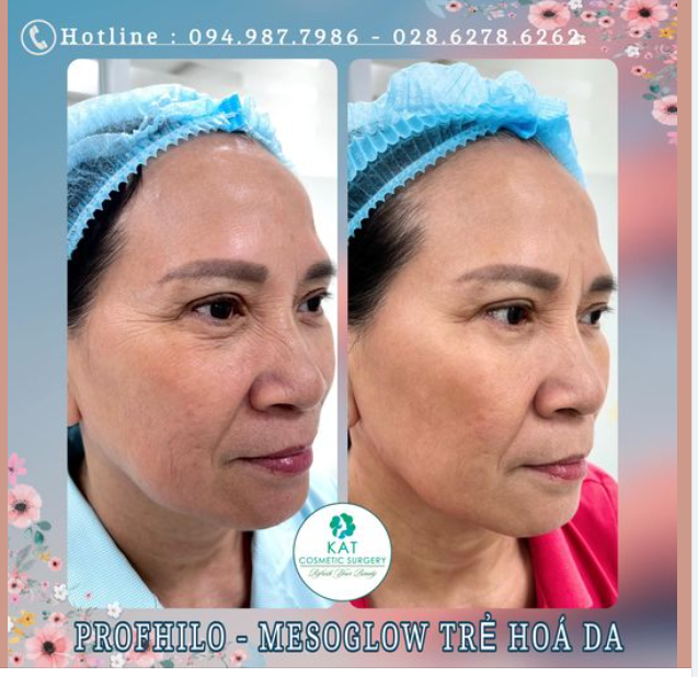 Theo thời gian lượng collagen trên da bị sụt giảm dẫn đến tốc độ lão