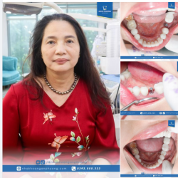 Cô Thơm là khách hàng răng sứ từ năm 2021, đồng thời cũng tin tưởng Ngân Phượng trong mọi dịch vụ chăm sóc răng miệng khác.