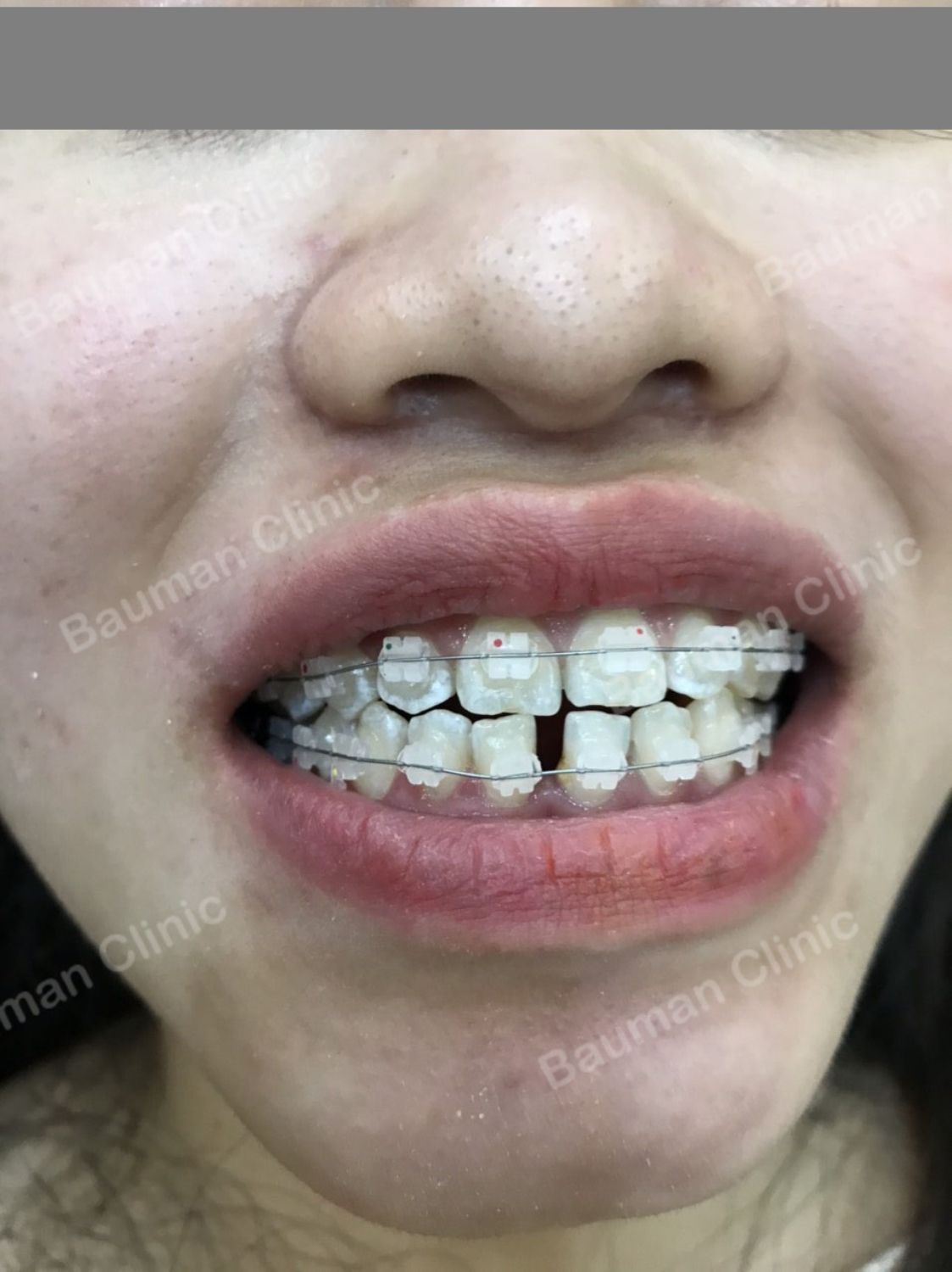 Ca niềng răng số 5086 - Nha khoa Bauman Clinic