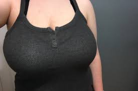 5 dấu hiệu cho thấy phẫu thuật thu gọn ngực là quy trình phù hợp với bạn