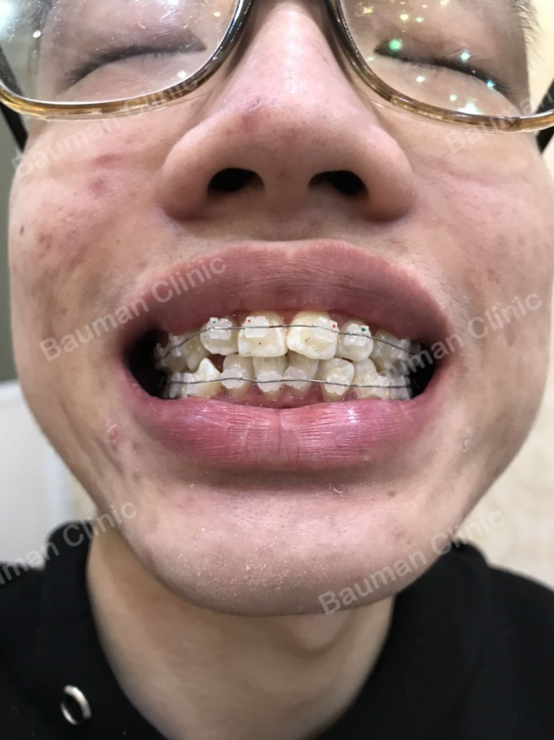 Ca niềng răng số 5092 - Nha khoa Bauman Clinic