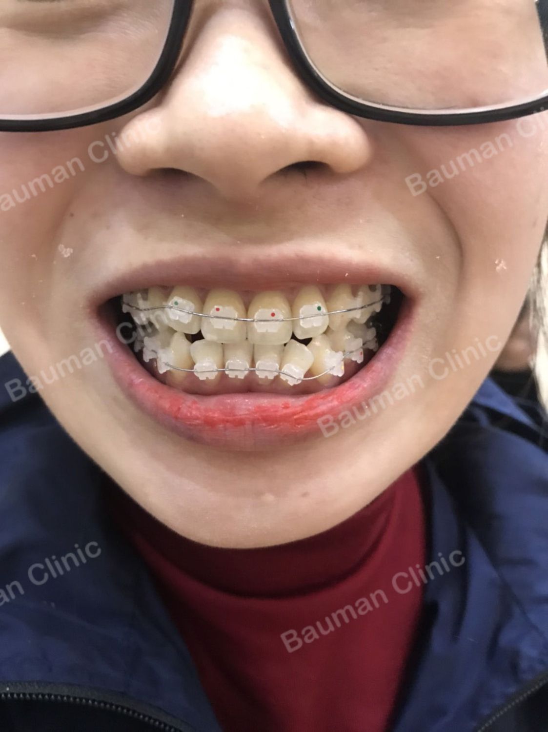 Ca niềng răng số 5091 - Nha khoa Bauman Clinic