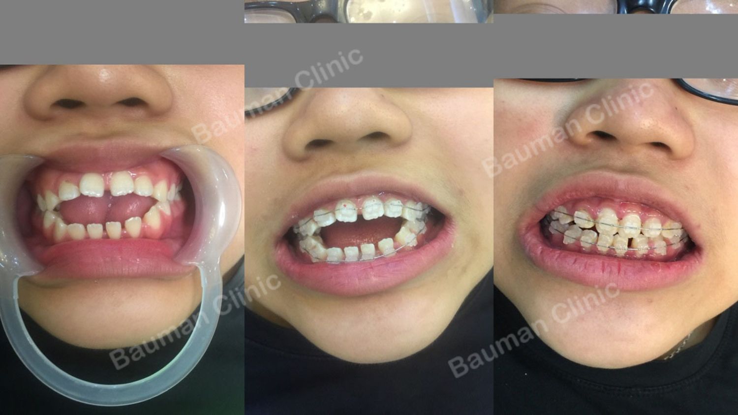 Ca niềng răng số 5069 - Nha khoa Bauman Clinic