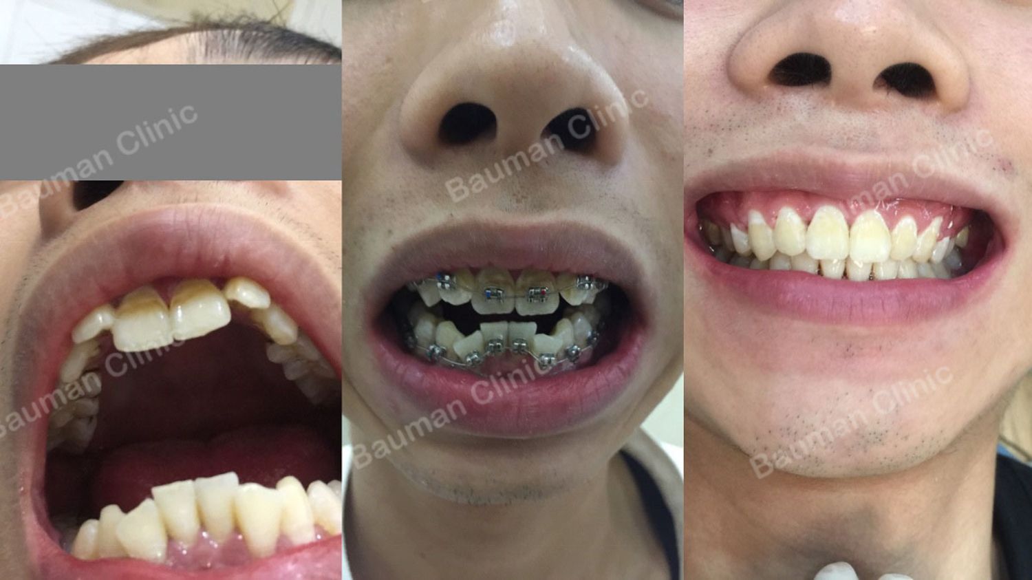 Ca niềng răng số 5076 - Nha khoa Bauman Clinic