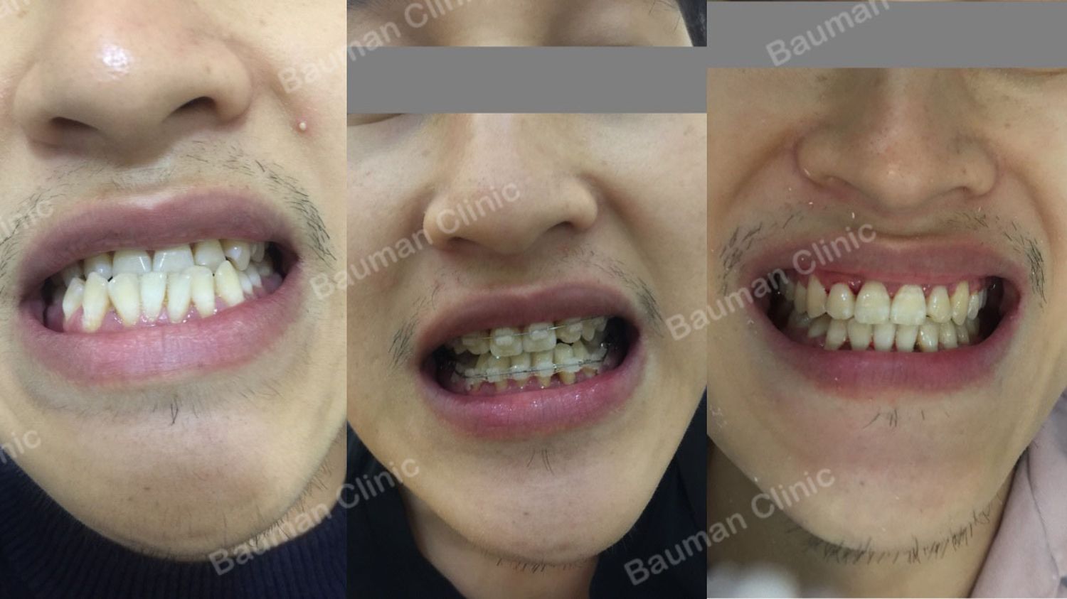 Ca niềng răng số 5077 - Nha khoa Bauman Clinic