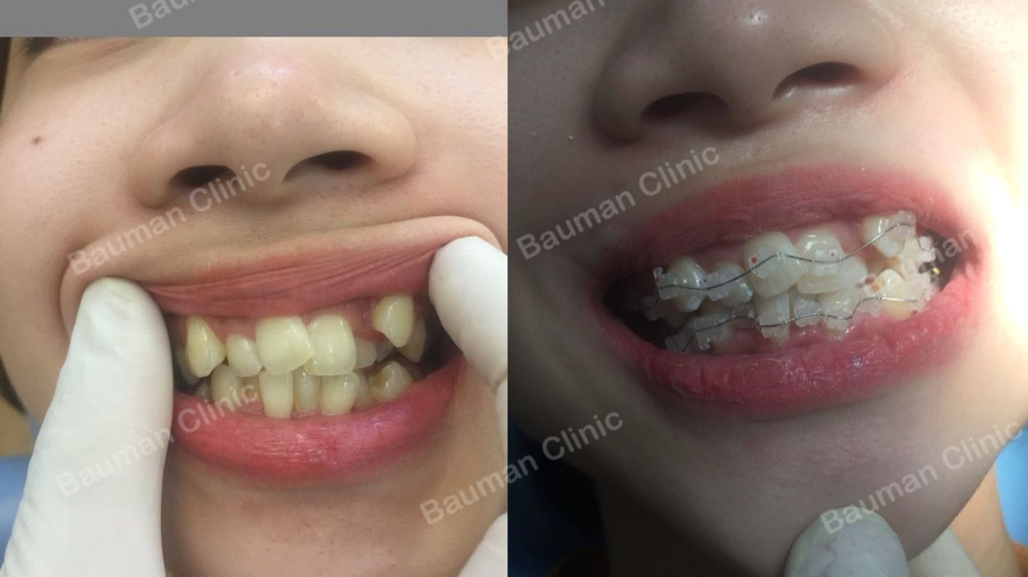 Ca niềng răng số 5078 - Nha khoa Bauman Clinic