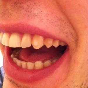 Có thể dán bonding sau niềng răng trong suốt invisalign không?