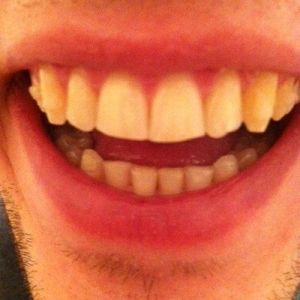 Có thể dán bonding sau niềng răng trong suốt invisalign không?
