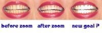Răng bị xỉn màu do dùng thuốc kháng sinh tetracycline: nên chọn mặt dán sứ Veneer hay mặt dán sứ Lumineer?