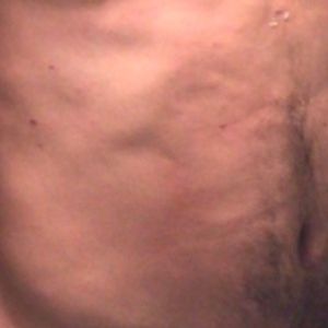 Da đổi màu và hình thành mô sẹo sau hút mỡ VASER Hi Def mạnh – 13 tuần sau điều trị, tôi nên làm gì tiếp theo?