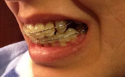 27 tuổi- niềng răng mắc cài trong suốt để khắc phục hô vẩu
