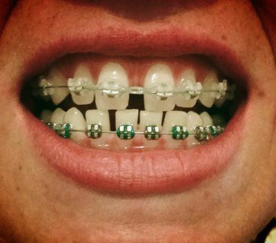 Niềng răng để khắc phục răng thưa