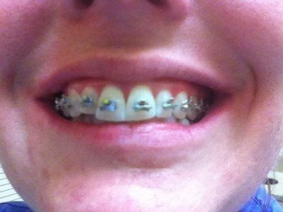 Niềng răng kim loại hiệu quả nhanh hơn và tốt hơn
