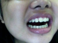 Hàm duy trì có thể dịch chuyển lại răng sau khi tháo niềng răng 6 tháng không?