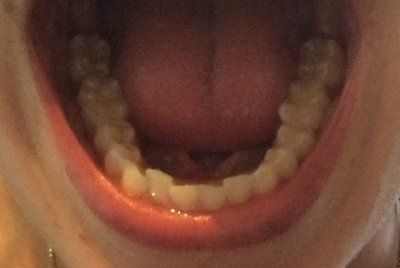 Hành trình niềng răng ở tuổi 22