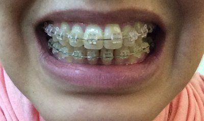 27 tuổi- niềng răng mắc cài trong suốt để khắc phục hô vẩu