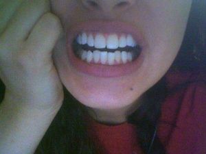 Lựa chọn niềng răng truyền thống hay niềng Invisalign đối với răng khấp khểnh, thưa và khớp cắn sâu?