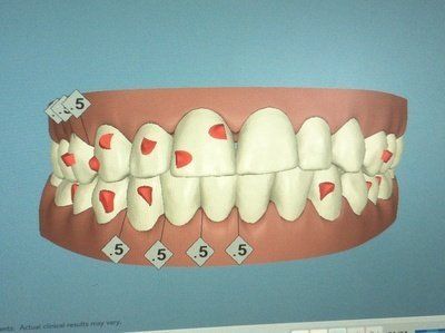 Niềng răng kim loại hiệu quả nhanh hơn và tốt hơn