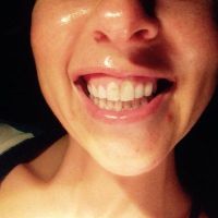 Cách xử lý răng cửa quá to và cười hở lợi