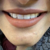 Cung hàm bị hẹp lại sau khi niềng răng thì cần làm gì?