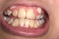 Răng nanh mọc lệch lên trên thì cần làm gì?