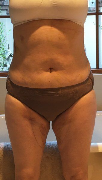 Quá trình hút mỡ căng mô ở bụng, hai bên sườn và hai bên đùi trong của bà mẹ 53 tuổi