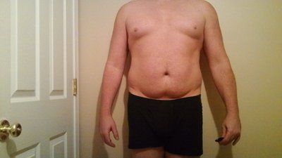 Hút mỡ cho nam giới: quý ông 40 tuổi với hành trình hút mỡ ngực, hai bên sườn, bụng, lưng