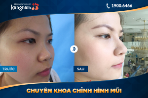 Hình ảnh nâng mũi trước sau thẩm mỹ Kangnam - Ca 30