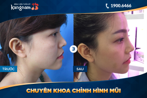Hình ảnh nâng mũi trước sau thẩm mỹ Kangnam - Ca 41