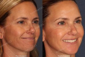 Hình ảnh tiêm Botox trước sau Dr Tâm – ca 29