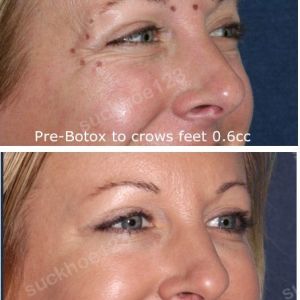 Hình ảnh tiêm Botox trước sau Dr Tâm – ca 34