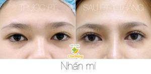 Hình ảnh nhấn mí trước và sau 1 tháng Bs Nguyễn Khanh - Ca 6