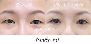 Hình ảnh nhấn mí trước và sau 7 tháng Bs Nguyễn Khanh - Ca 8