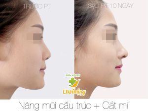 Hình ảnh nâng mũi cấu trúc Bs Nguyễn Khanh - Ca 30