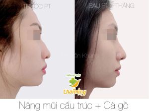 Hình ảnh nâng mũi cấu trúc kết hợp cà gồ Bs Nguyễn Khanh - Ca 31