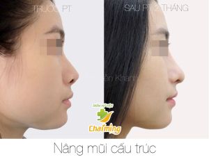 Hình ảnh nâng mũi cấu trúc Bs Nguyễn Khanh - Ca 37