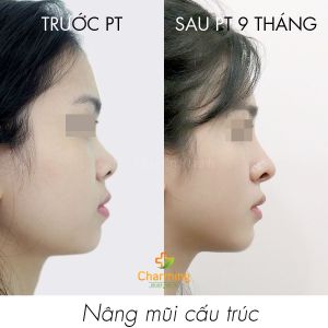 Hình ảnh nâng mũi cấu trúc Bs Nguyễn Khanh - Ca 39