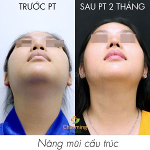 Hình ảnh nâng mũi cấu trúc Bs Nguyễn Khanh - Ca 40