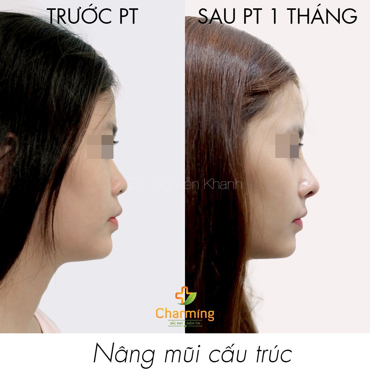 Hình ảnh nâng mũi cấu trúc Bs Nguyễn Khanh - Ca 41