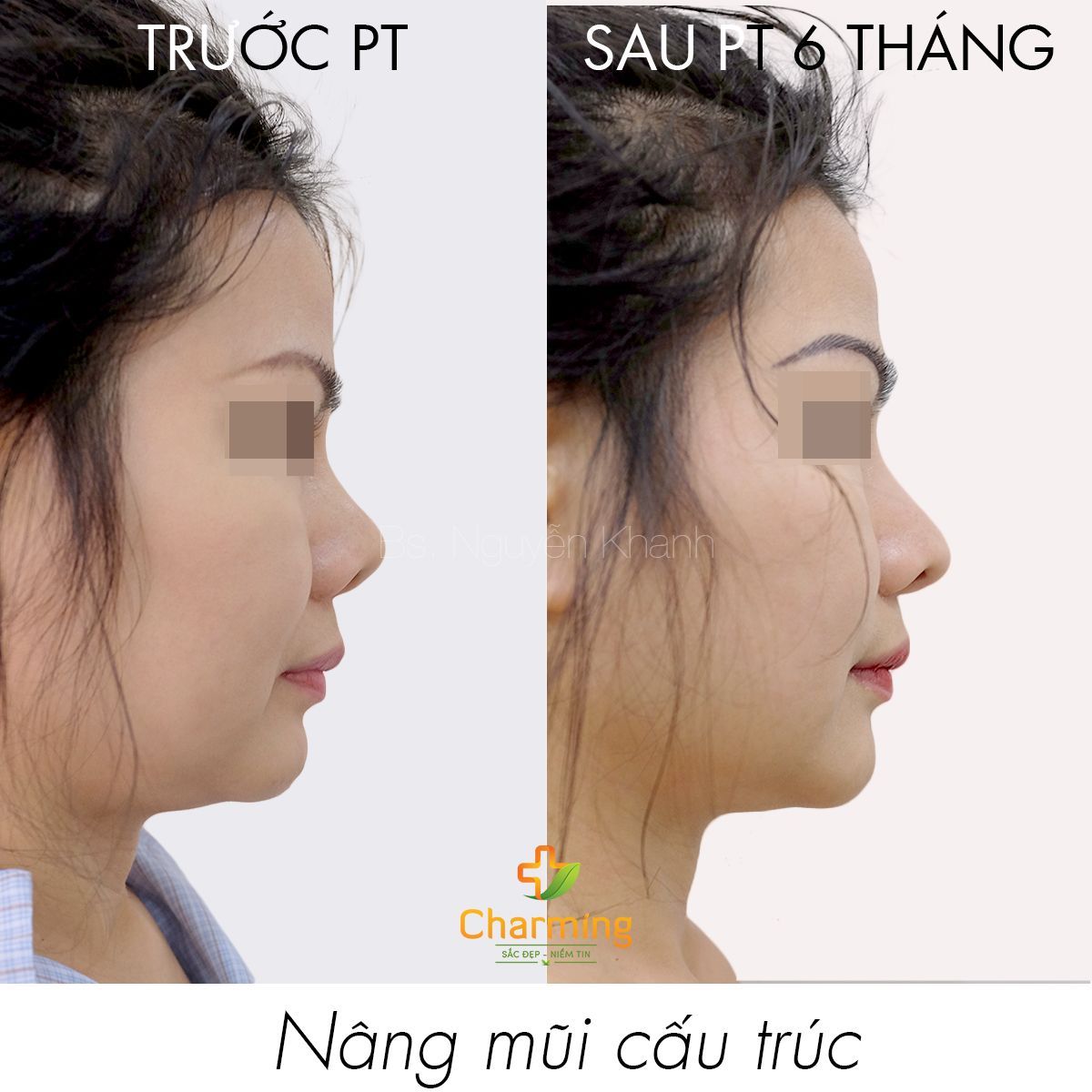 Hình ảnh nâng mũi cấu trúc trước sau 6 tháng Bs Nguyễn Khanh