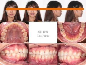 Hình ảnh niềng răng mặt trong làm thay đổi khuôn mặt ở một ca hô xương BS Việt Anh - ca 1
