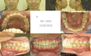 Hình ảnh niềng răng mặt trong làm thay đổi khuôn mặt ở một ca hô xương BS Việt Anh - ca 1