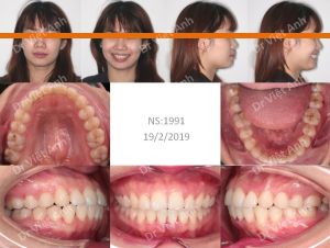 Hình ảnh niềng răng khấp khểnh trong 7 tháng Bs Việt Anh - Ca 2
