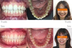Hình ảnh niềng răng khấp khểnh trong 7 tháng Bs Việt Anh - Ca 2